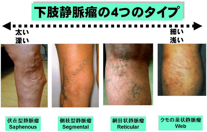 静脈瘤ストリッピング中に何が期待できますか?